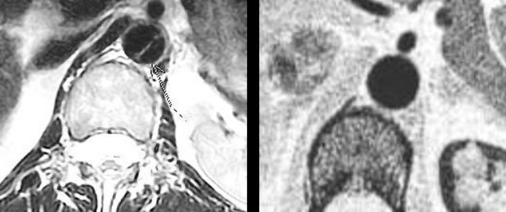 Lively Stones Mission Tris Griffin MRI before and after cancer heart