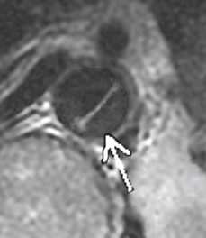 Lively Stones Mission Tris Griffin MRI with pointing arrow to the aorta cancer